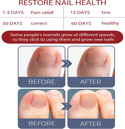 ToePerfect™ Nagelserum – Intensieve Verzorging voor Teen- & Handnagels [1+1 Gratis]