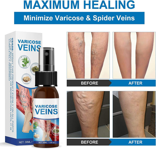 VeinSpray™ – Verlicht onmiddellijk zwellingen en klachten door spataderen [1 + 1 Gratis]