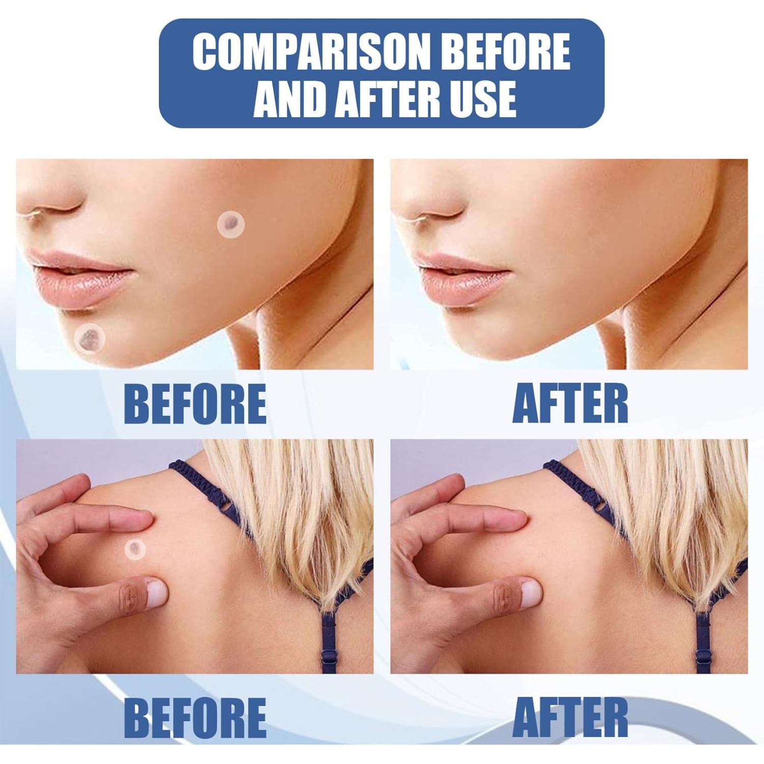 DermaFix™ - Kit voor geavanceerde wratverwijdering [1 + 1 Gratis]