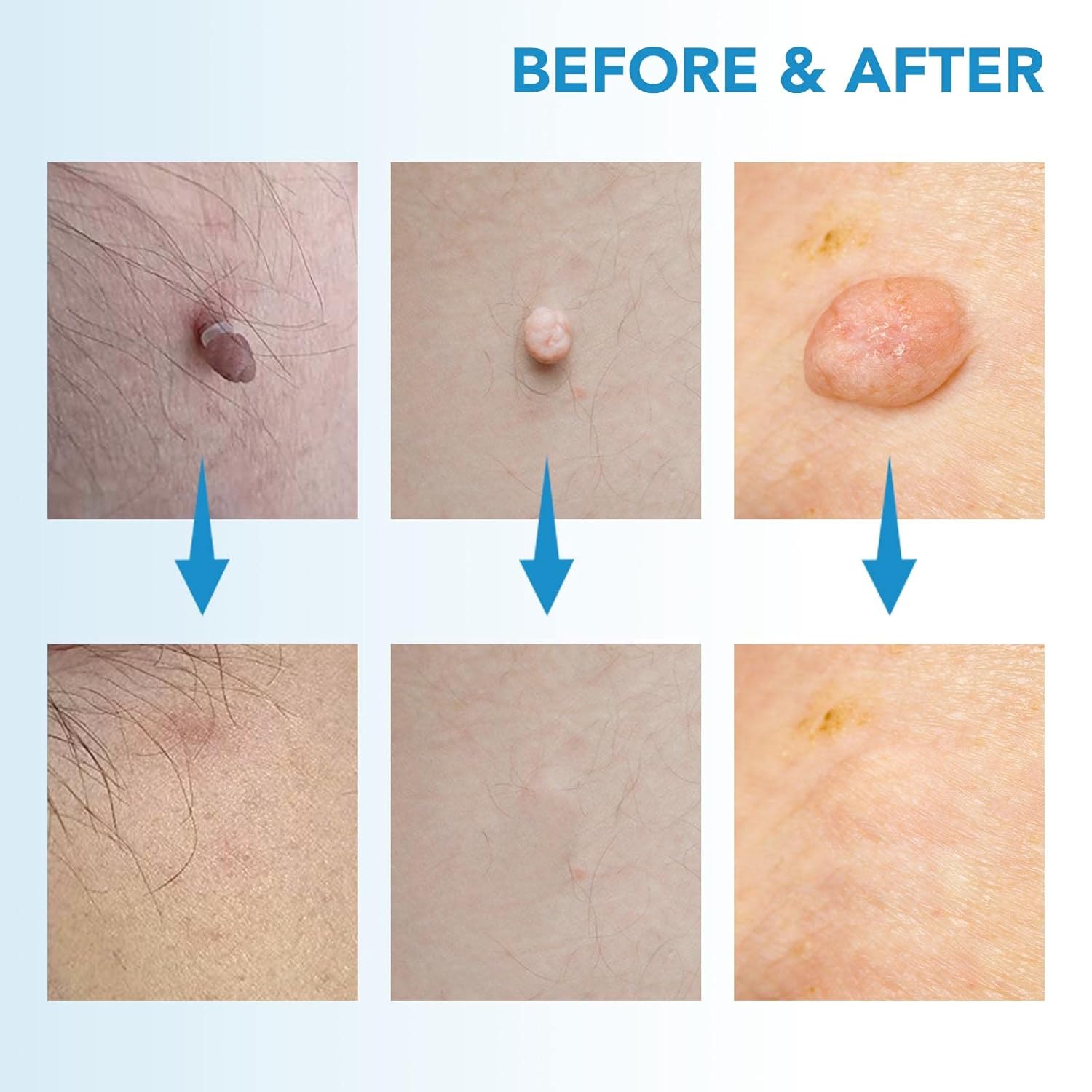 DermaFix™ - Kit voor geavanceerde wratverwijdering [1 + 1 Gratis]