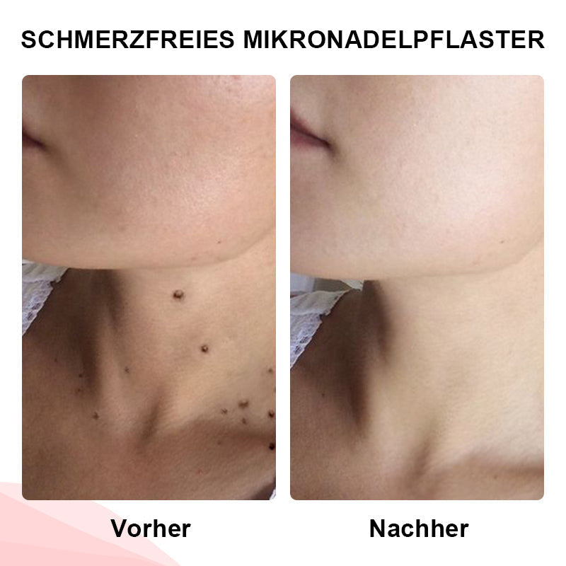 Odalit™ - Pijnloze verwijdering van huidincisies [1 + 1 Gratis]