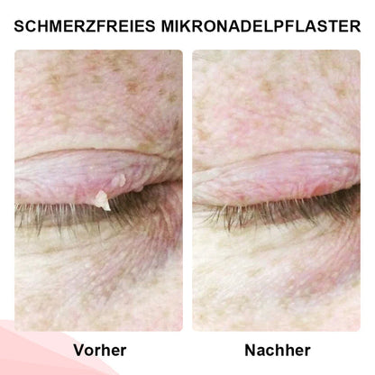 Odalit™ - Pijnloze verwijdering van huidincisies [1 + 1 Gratis]