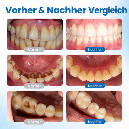 SmileHap – Tandbeschermingsserum voor stralend mooie tanden [50% korting]