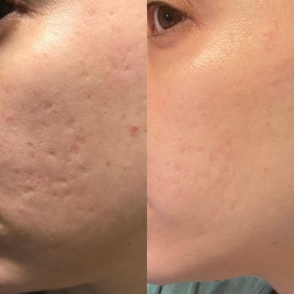 NuSkin™ Anti-Rimpelpleisters – Gladde & Jeugdige Huid [2+2 Gratis]