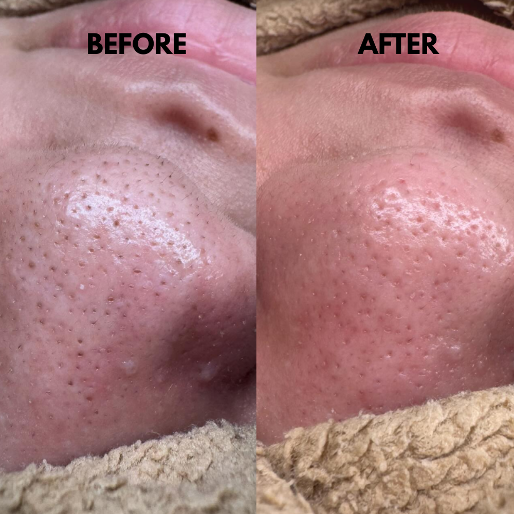 SkinSonic™ – Ultrasone Skin Scrubber voor Diepe Poriënreiniging & Stralende Huid