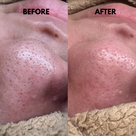 SkinSonic™ – Ultrasone skin scrubber, diepe reiniging & stralende, gezonde huid [50% Korting]