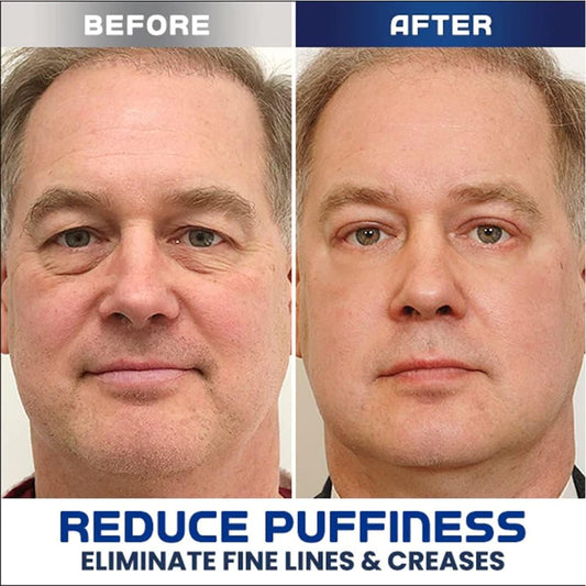 LumiLift™ – Peptideformule voor vermindering van zwellingen & voor een verstevigend effect [1 + 1 Gratis]