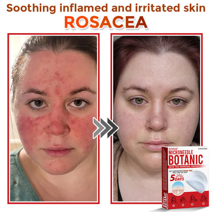 SkinTag™ Huidflapjes Verwijderen – Zachte Micro-Patches [1+1 Gratis]