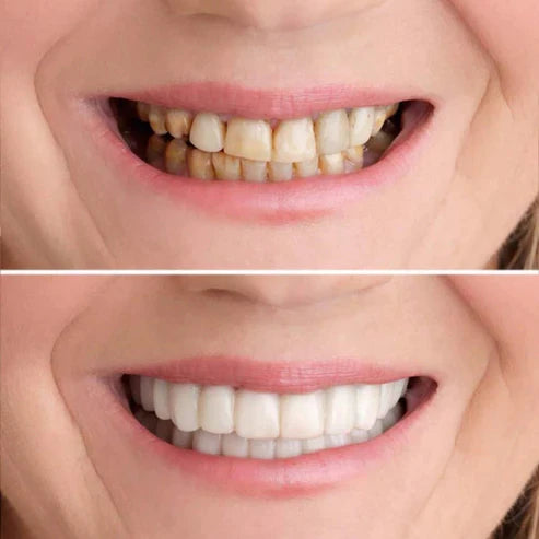 1 + 1 Gratis | JustWhite™  Voor de perfecte witte glimlach! [Laatste dag korting]