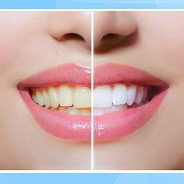 WhiteEssence™ – Tandenbleekpen voor stralend witte & gezonde tanden [1 + 1 Gratis]