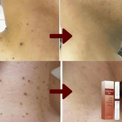 1 + 1 Gratis |  WipeOff™ - Verwijder hardnekkige vlekken en wratten [Laatste dag korting].