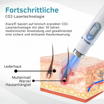 Klara™ Pijnloze Laserpen – Verwijder Moedervlekken & Wratten Thuis