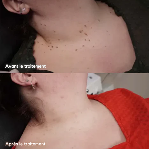 NatureDerm™ – Verwijdert zacht en effectief huidgroei en huidvlekken [1 + 1 Gratis]