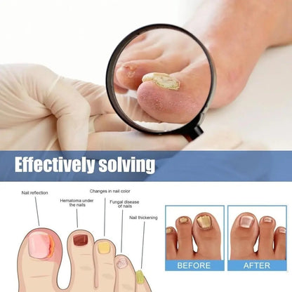 FungalPatch™ – Schimmelnagel Patch voor Snelle & Zichtbare Nagelverzorging