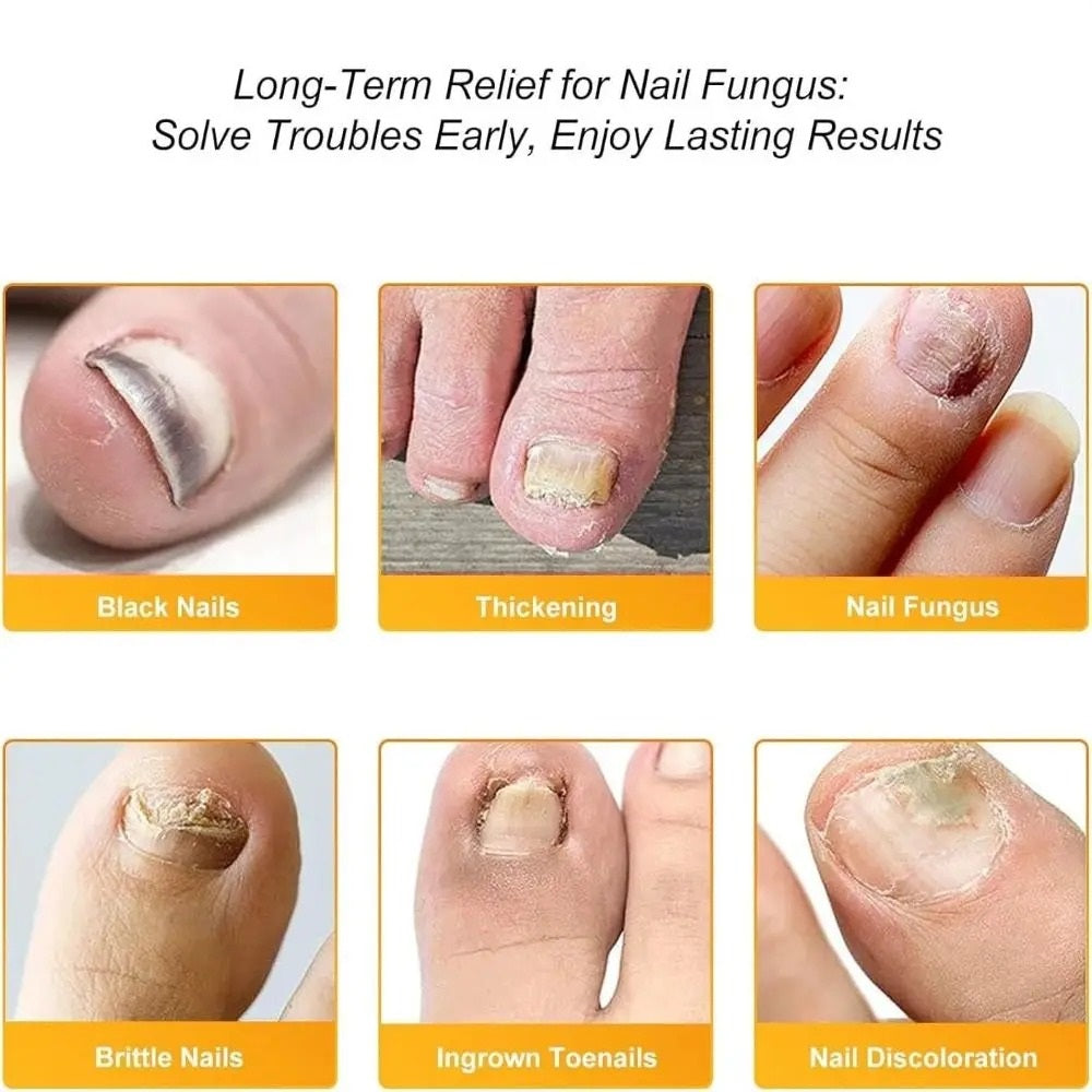 FungalPatch™ – Schimmelnagel Patch voor Snelle & Zichtbare Nagelverzorging