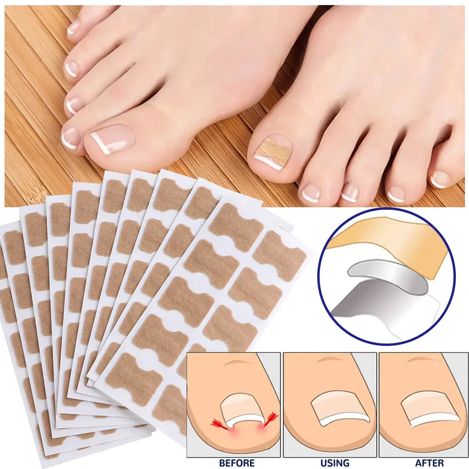 NailCare™ – Ingegroeide Nagels Corrigeren | Pijnvrije Voeten