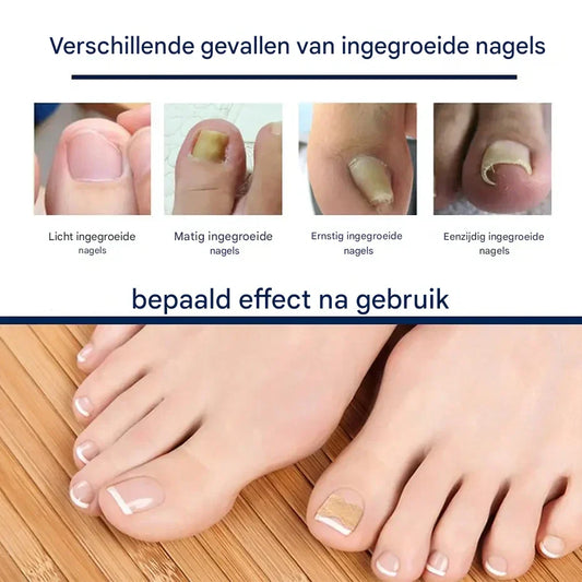 HealthNail™ – Verfraai je natuurlijke nagels op een zachte, duurzame manier [25 + 25 Gratis]