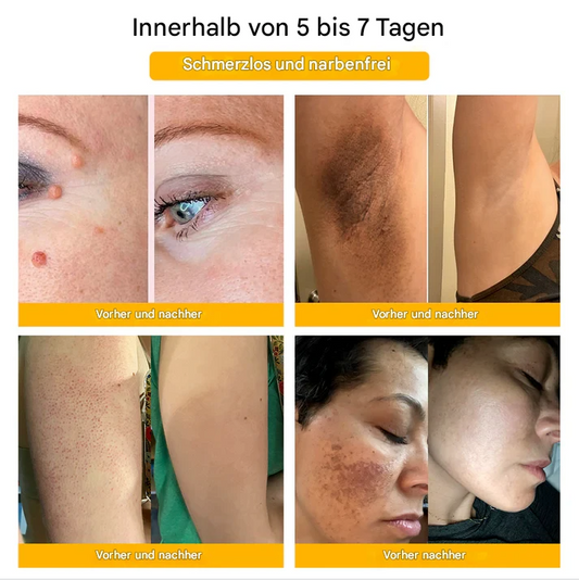 TagAway™ – Effectieve verwijdering van wratten & huidgroei voor een gladde, heldere huid [1 + 1 Gratis]