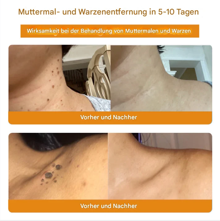 TagAway™ – Plantaardige Wrat & Huidtag Verwijdering | 1 + 1 Gratis