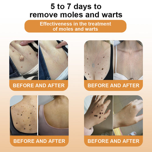 SkinTag™ – Bijengezwel-formule, pijnloze toepassing voor vlekkeloze huid [50% Korting]