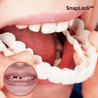 SnapLock Flexibele Tandcover – Natuurlijk Witte Glimlach in Seconden