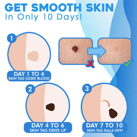 DermFree™ – Pijnloze, zachte en effectieve verwijdering [50% Korting]