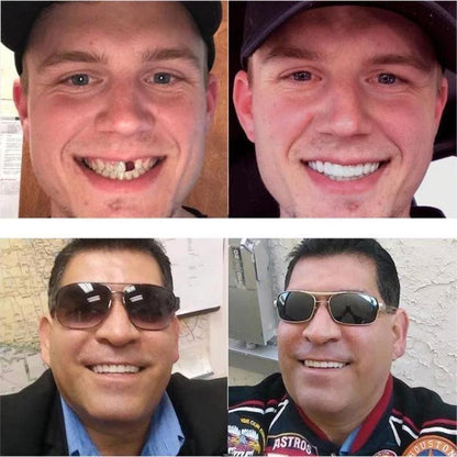 SnapOn™ - Opklikbare prothese voor een stralende lach [1 + 1 Gratis]