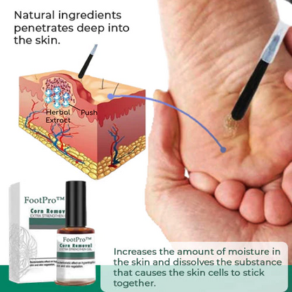 FootPro™ - Likdoornverwijdering Extra Sterke Gel [1 + 1 Gratis]