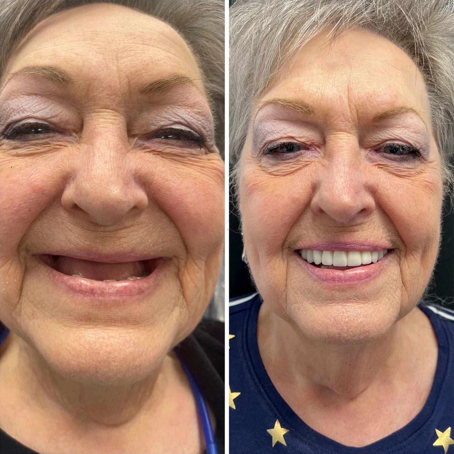 SmileKit – Perfecte Glimlach in Seconden 50% Korting