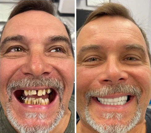 SmileKit – Perfecte Glimlach in Seconden 50% Korting