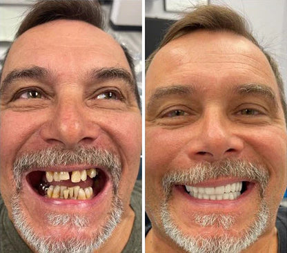 SmileKit – Perfecte Glimlach in Seconden 50% Korting