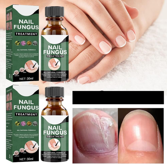 NagelPilz™ – Geneest, regenereert & beschermt beschadigde nagels [1 + 1 Gratis]