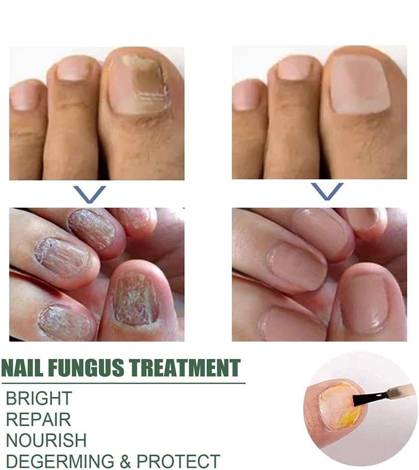 NagelPilz™ – Geneest, herstelt & beschermt beschadigde nagels [50% Korting]