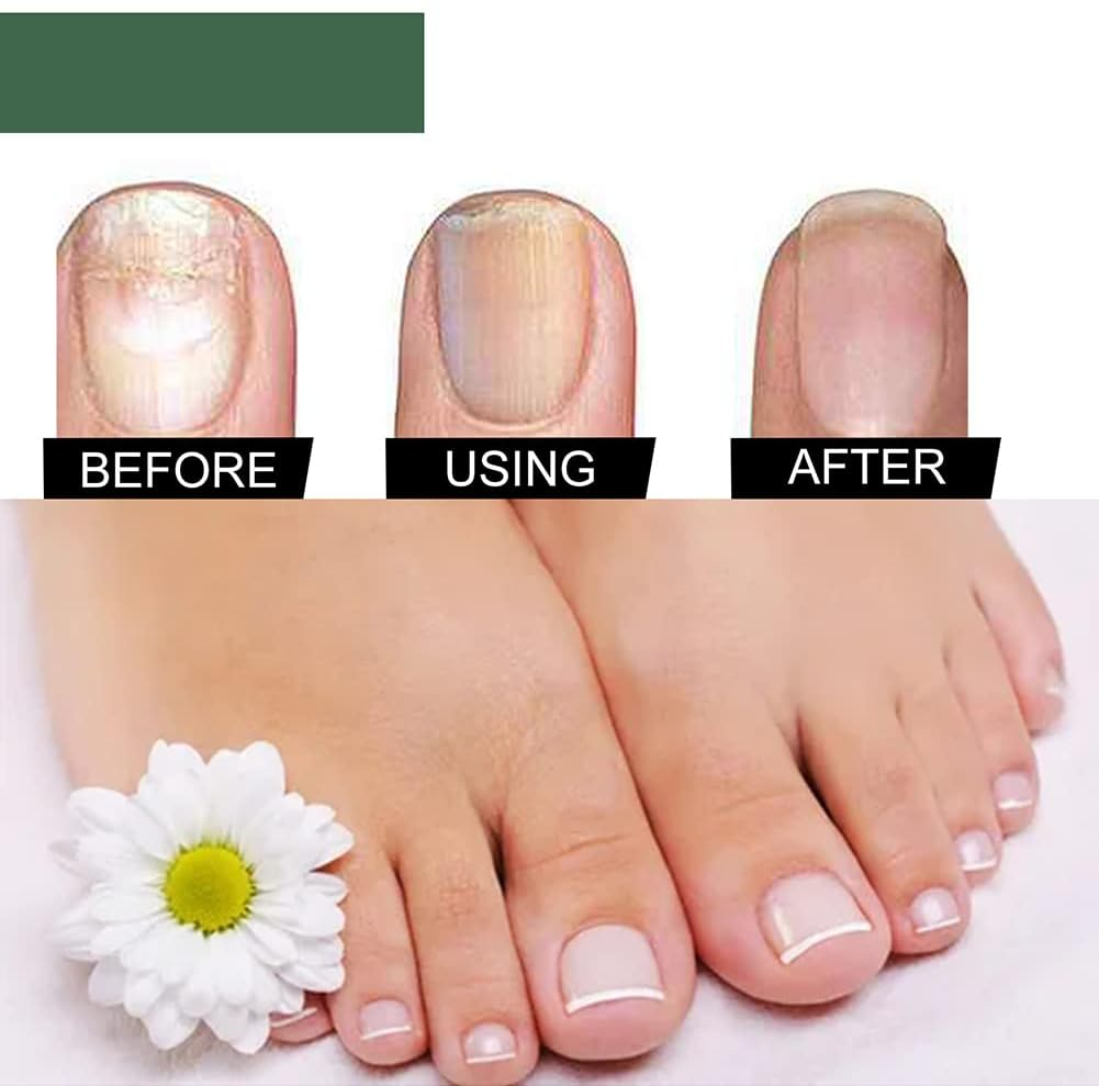 NagelPilz™ – Geneest, herstelt & beschermt beschadigde nagels [50% Korting]