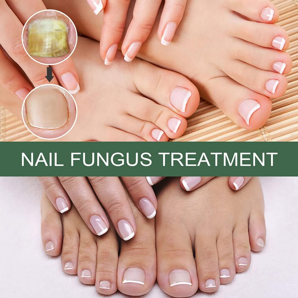 NagelPilz™ – Geneest, herstelt & beschermt beschadigde nagels [50% Korting]