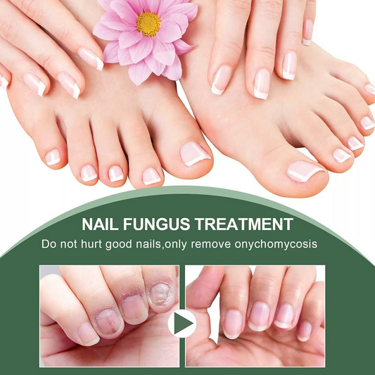 NagelPilz™ – Geneest, herstelt & beschermt beschadigde nagels [50% Korting]