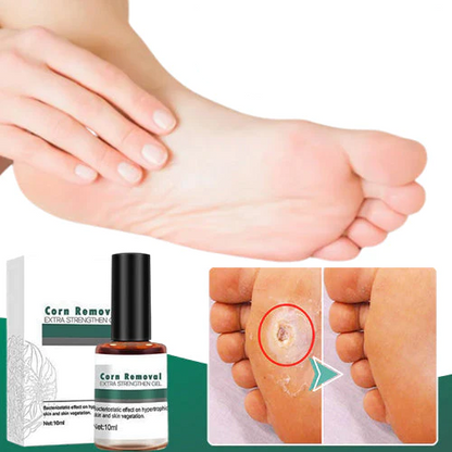 CallusClear™ – Eelt- en likdoornverwijderaar met extra sterke verlichting [1 + 1 Gratis]