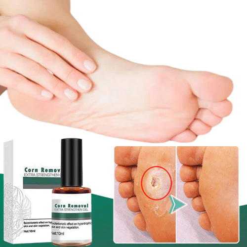 CallusClear™ – Eelt- en likdoornverwijderaar met extra krachtige verlichting [1 + 1 Gratis]