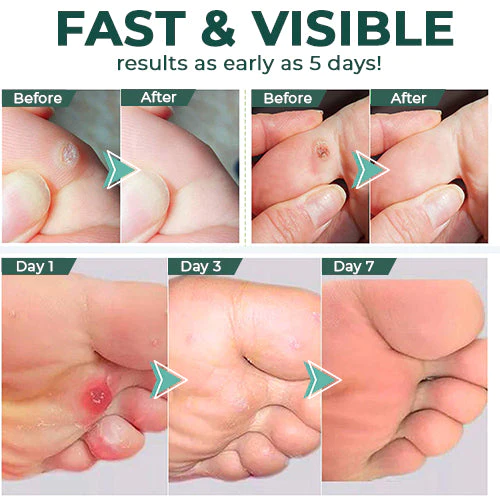 CallusClear™ – Eelt- en likdoornverwijderaar met extra sterke verlichting [1 + 1 Gratis]