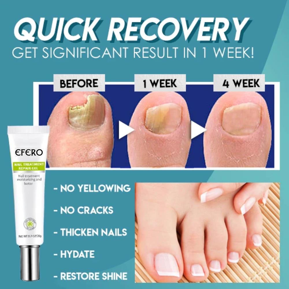 NailRepair™ – Snelle, effectieve en langdurige resultaten [1 + 1 Gratis]
