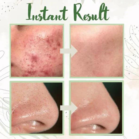 DermaTea™ – Groene Thee Masker Stick voor Diepe Poriënreiniging [1+1 Gratis]