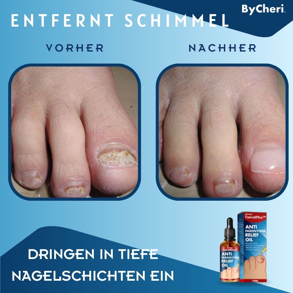 HeilungsTropfen™ - Herstel beschadigde nagels in 4 weken [1 + 1 Gratis]
