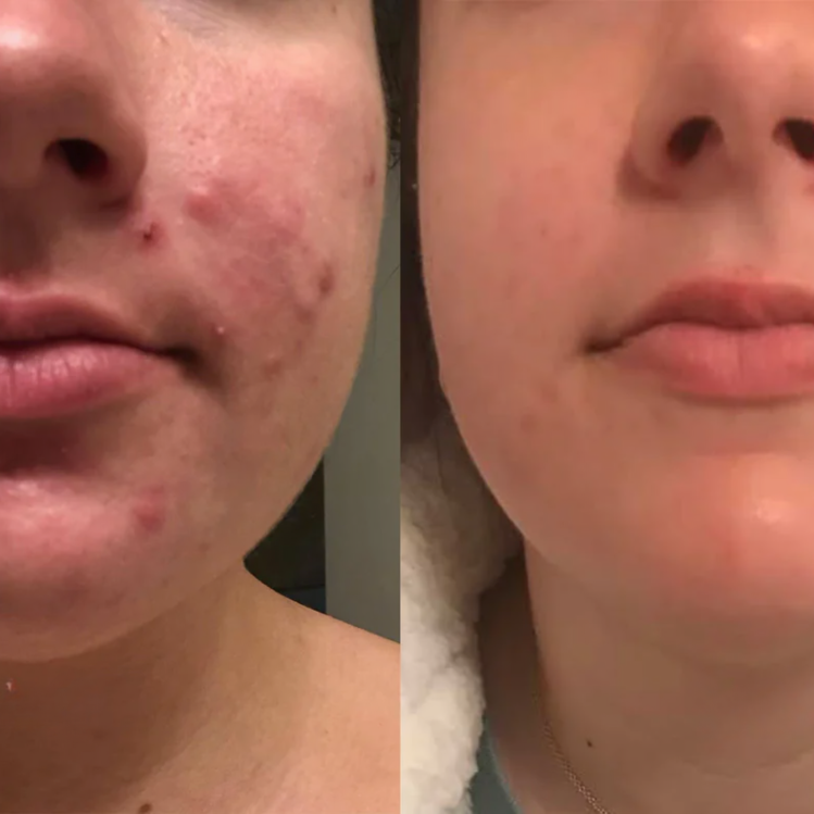 Dermiva™ – Zachte Siliconenpleisters voor Littekens [1 + 1 Gratis]