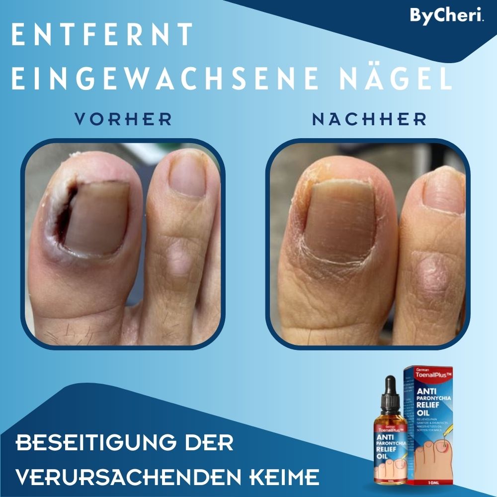 HeilungsTropfen™ - Herstel beschadigde nagels in 4 weken [1 + 1 Gratis]