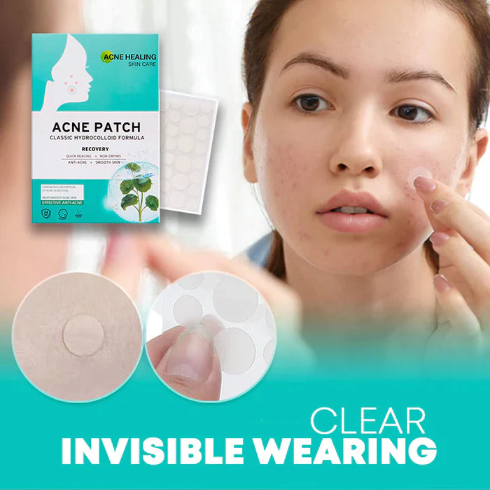AcNatch Acnepleisters – Hydrocolloïd Puistjespleisters voor een Heldere Huid
