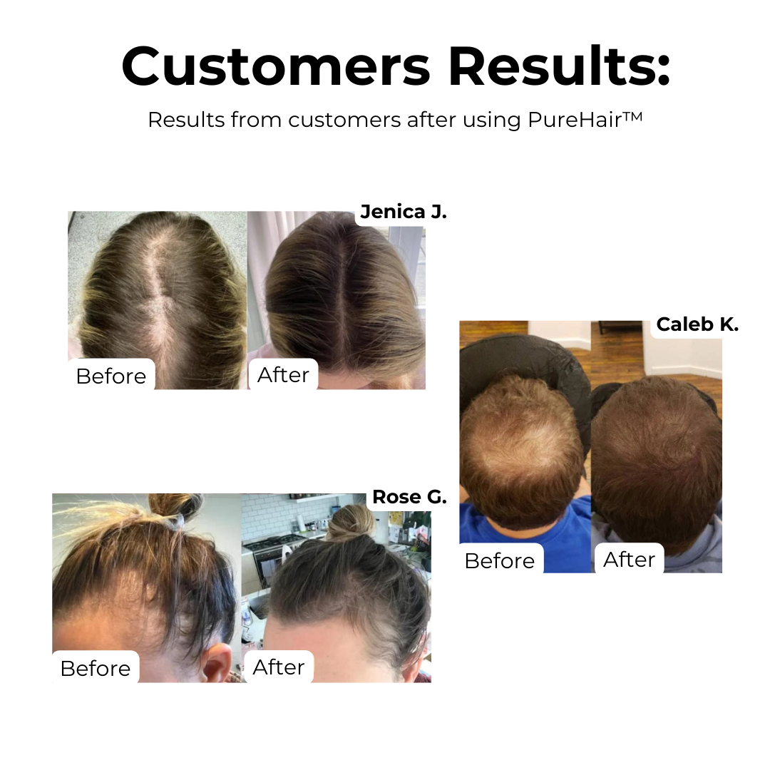 PureHair™ – Natuurlijke Haargroei Olie tegen Haaruitval [1+1 Gratis]