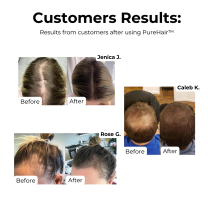 PureHair™ – Natuurlijke Haargroei Olie tegen Haaruitval [1+1 Gratis]