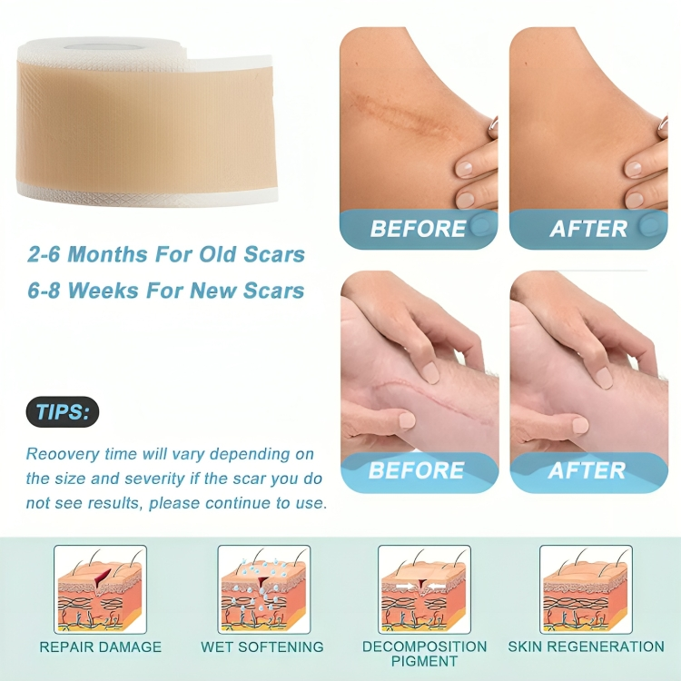 Dermiva™ – Zachte Siliconenpleisters voor Littekens [1 + 1 Gratis]