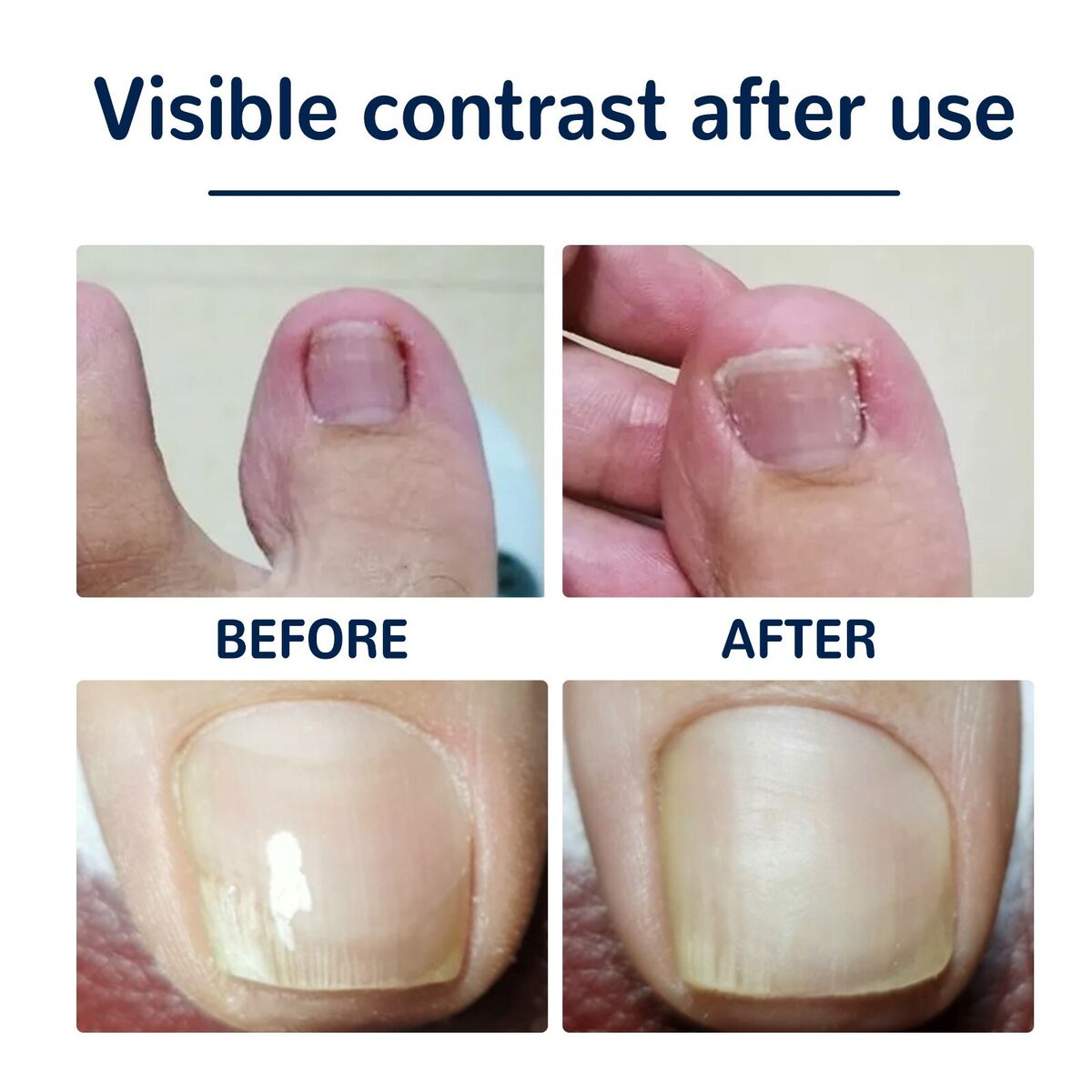 NailLift™ – Correctiepads voor Ingegroeide Teennagels | 1+1 Gratis