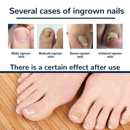 NailLift™ – Correctiepads voor Ingegroeide Teennagels | 1+1 Gratis